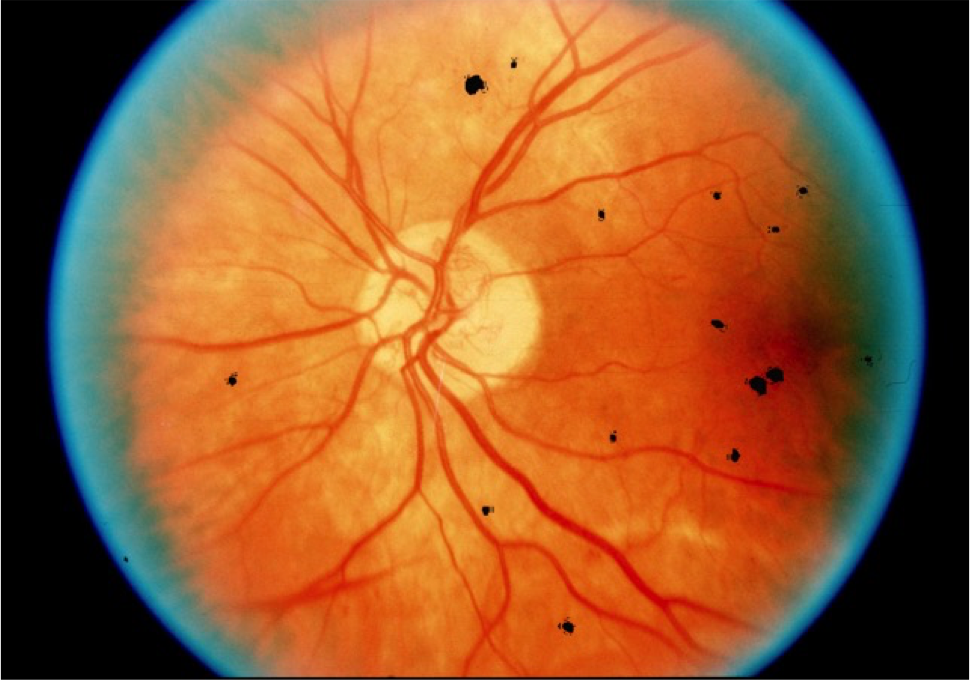 This is how optometrists see RetinaLyze results: black spots showing the presence of early signs of Diabetic Retinopathy - in real time in 30 seconds from sending a taken picture to the cloud. [www.retinalyze.pl]